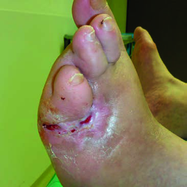 Wundverlauf diabetisches Fußsyndrom – Tag 83