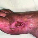 Wundverlauf postoperative Wundheilungsstörung – Tag 0