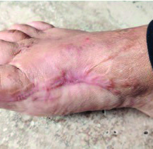 Wundverlauf postoperative Wundheilungsstörung – Tag 13